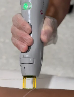 clase depilacion laser florida