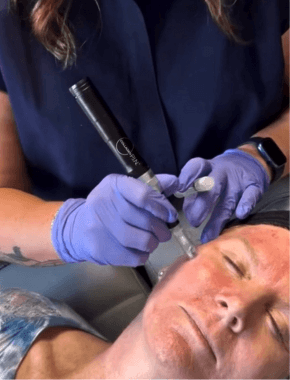 microneedling bhi tampa