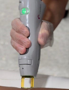 hypertrichosis training tampa